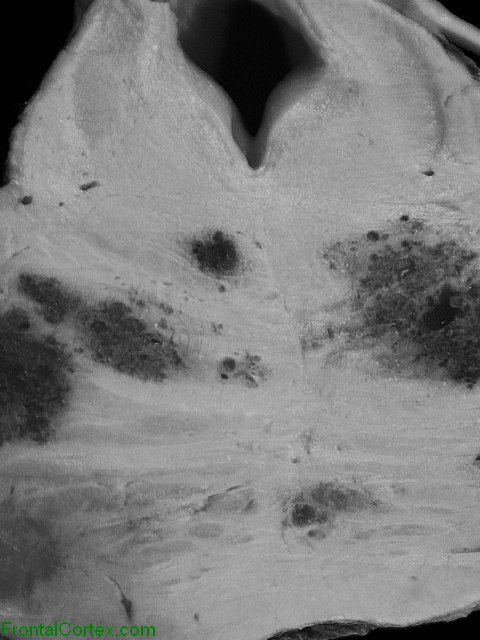 Multiple cavernous angiomas, transverse section of pons, close-up